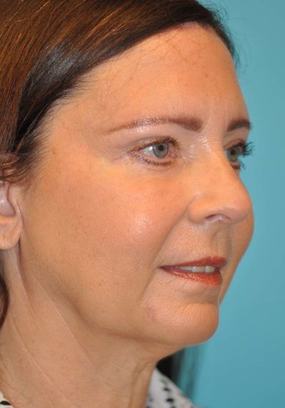Browlift Before and After Photos Case 6068 After Photo Browlift Before and After Photos