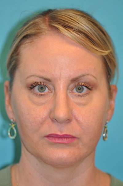 Rhinoplasty (Nose Job) Before and After Photos Case 6088 After Photo Rhinoplasty (Nose Job) Before and After Photos
