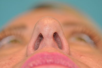 Rhinoplasty (Nose Job) Before and After Photos Case 6088 After Photo Rhinoplasty (Nose Job) Before and After Photos