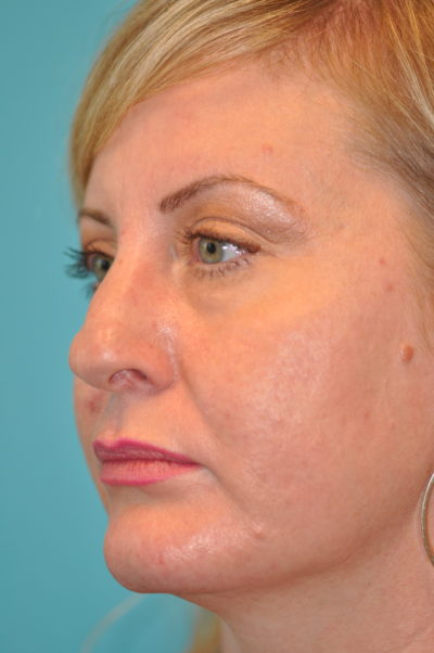 Rhinoplasty (Nose Job) Before and After Photos Case 6088 Before Photo Rhinoplasty (Nose Job) Before and After Photos