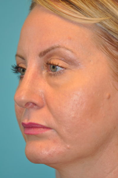 Rhinoplasty (Nose Job) Before and After Photos Case 6088 After Photo Rhinoplasty (Nose Job) Before and After Photos