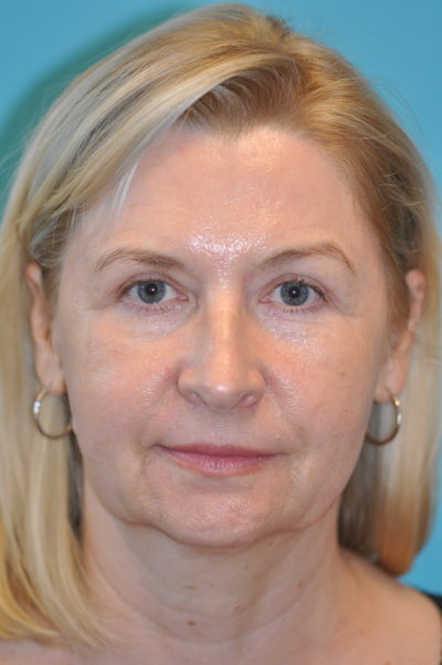 Upper Blepharoplasty (Eyelid)