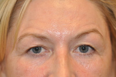 Upper Blepharoplasty (Eyelid)