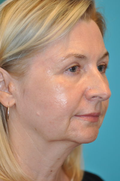 Upper Blepharoplasty (Eyelid)