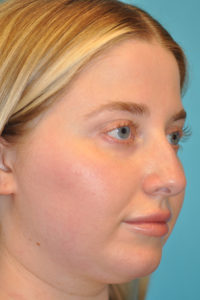 Rhinoplasty (Nose Job) Before and After Photos