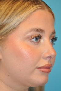 Rhinoplasty (Nose Job) Before and After Photos