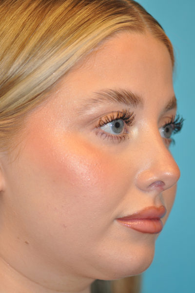 Rhinoplasty (Nose Job) Before and After Photos Case 6098 After Photo Rhinoplasty (Nose Job) Before and After Photos