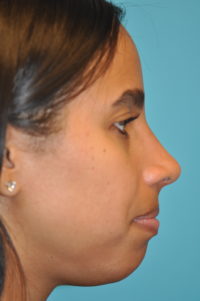 Rhinoplasty (Nose Job) Before and After Photos