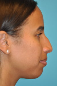 Rhinoplasty (Nose Job) Before and After Photos