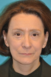 Facelift and Necklift Before and After Photos