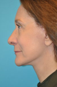 Facelift and Necklift Before and After Photos