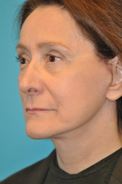 Rhytidectomy (Facelift) Before and After Photos