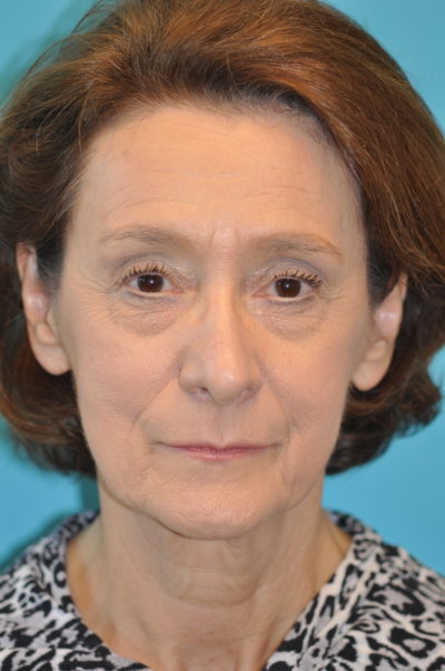 Rhytidectomy (Facelift) Before and After Photos