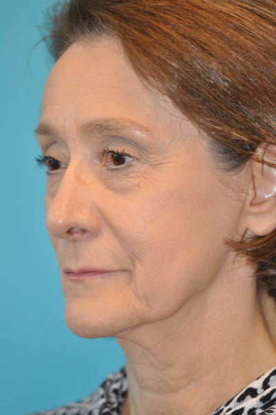 Rhytidectomy (Facelift)