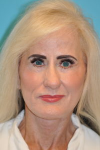 Facelift and Necklift Before and After Photos