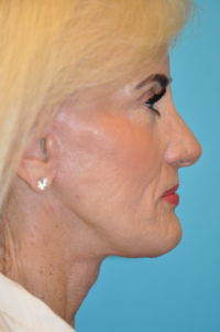 Rhytidectomy (Facelift) Before and After Photos