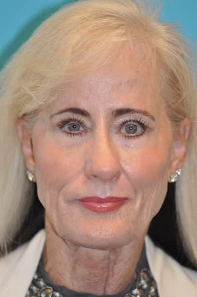 Facelift and Necklift Before and After Photos