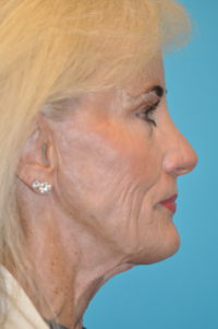 Facelift and Necklift Before and After Photos