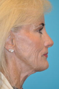 Rhytidectomy (Facelift) Before and After Photos