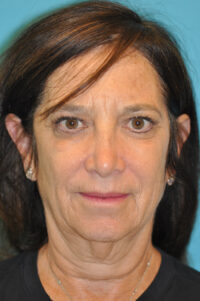 Facelift and Necklift Before and After Photos