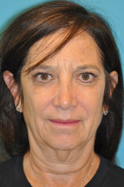 Facelift and Necklift Before and After Photos Case 6190 Before Photo Facelift and Necklift Before and After Photos