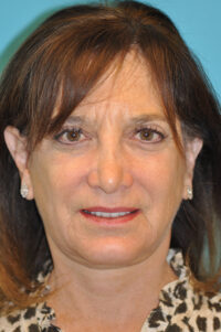 Facelift and Necklift Before and After Photos