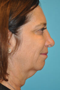 Facelift and Necklift Before and After Photos