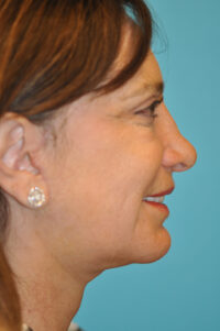 Facelift and Necklift Before and After Photos