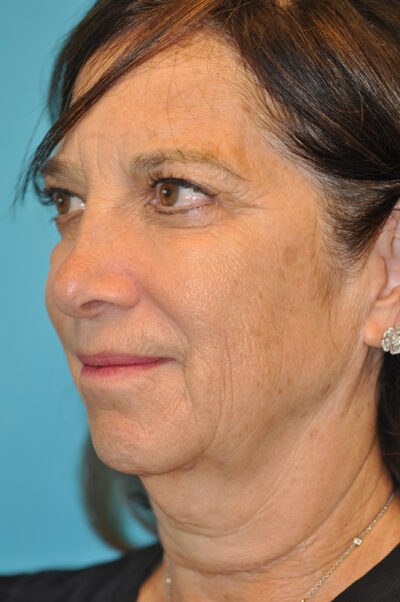 Facelift and Necklift Before and After Photos Case 6190 Before Photo Facelift and Necklift Before and After Photos