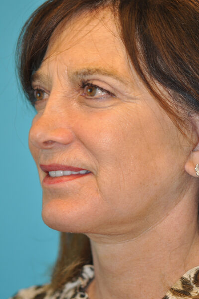Facelift and Necklift Before and After Photos Case 6190 After Photo Facelift and Necklift Before and After Photos