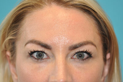 Upper Blepharoplasty (Eyelid) Before and After Photos