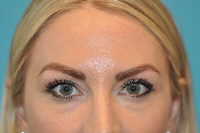 Upper Blepharoplasty (Eyelid) Before and After Photos