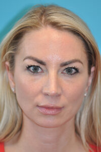 Chin Implant Before and After Photos