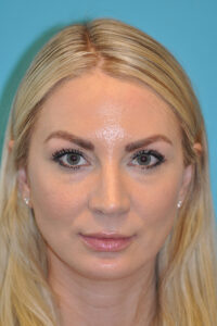 Chin Implant Before and After Photos