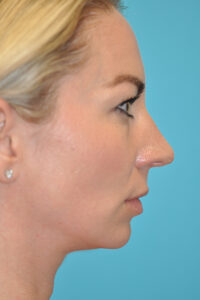 Chin Implant Before and After Photos