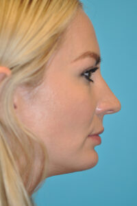 Chin Implant Before and After Photos