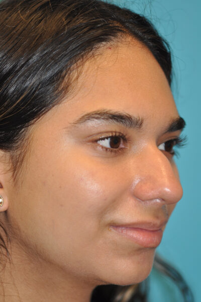 Rhinoplasty (Nose Job) Before and After Photos Case 6223 Before Photo Rhinoplasty (Nose Job) Before and After Photos