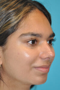 Rhinoplasty (Nose Job) Before and After Photos