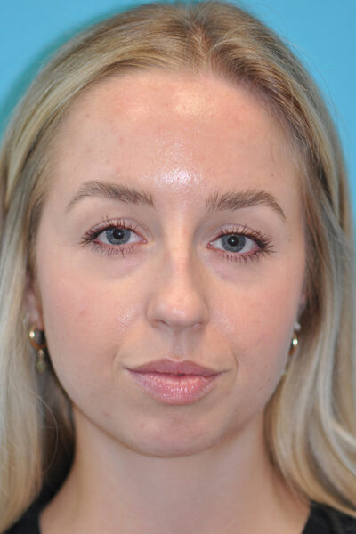 Rhinoplasty (Nose Job) Before and After Photos Case 6388 Before Photo Rhinoplasty (Nose Job) Before and After Photos