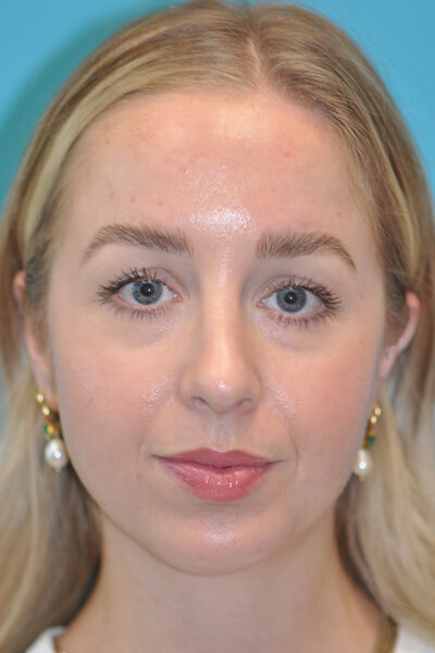 Rhinoplasty (Nose Job) Before and After Photos Case 6388 After Photo Rhinoplasty (Nose Job) Before and After Photos