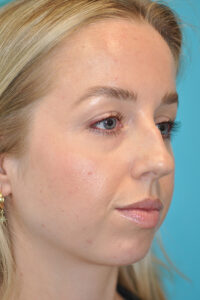 Rhinoplasty (Nose Job) Before and After Photos