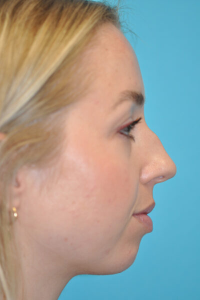 Rhinoplasty (Nose Job) Before and After Photos Case 6388 Before Photo Rhinoplasty (Nose Job) Before and After Photos