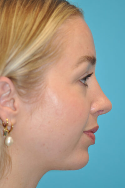 Rhinoplasty (Nose Job) Before and After Photos Case 6388 After Photo Rhinoplasty (Nose Job) Before and After Photos