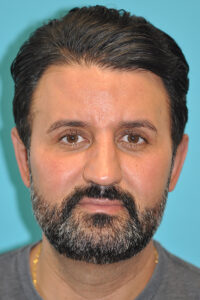 Otoplasty (Ear Reduction) Before and After Photos