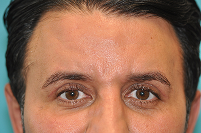 Upper Blepharoplasty (Eyelid) Before and After Photos