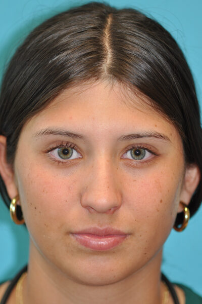 Rhinoplasty (Nose Job) Before and After Photos Case 9206 Before Photo Rhinoplasty (Nose Job) Before and After Photos