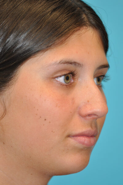 Rhinoplasty (Nose Job) Before and After Photos