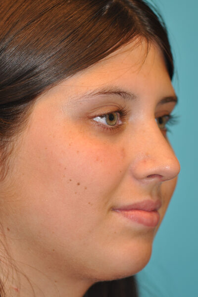 Rhinoplasty (Nose Job) Before and After Photos