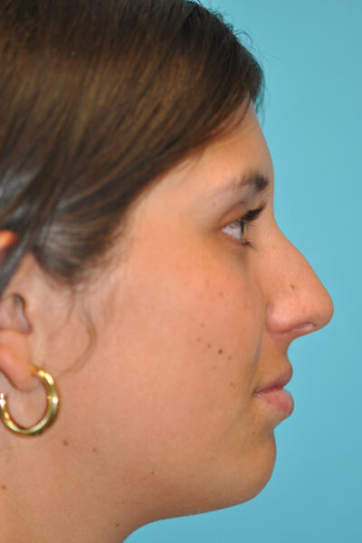 Rhinoplasty (Nose Job) Before and After Photos