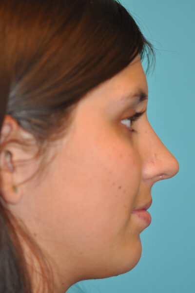 Rhinoplasty (Nose Job) Before and After Photos Case 9206 After Photo Rhinoplasty (Nose Job) Before and After Photos